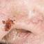 33. Basal Cell Carcinoma Nose Pictures