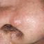 34. Basal Cell Carcinoma Nose Pictures