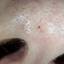 35. Basal Cell Carcinoma Nose Pictures