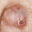 36. Basal Cell Carcinoma Nose Pictures