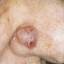 37. Basal Cell Carcinoma Nose Pictures