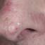38. Basal Cell Carcinoma Nose Pictures