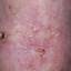 39. Basal Cell Carcinoma Nose Pictures