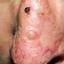 4. Basal Cell Carcinoma Nose Pictures