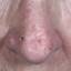 41. Basal Cell Carcinoma Nose Pictures