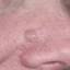 42. Basal Cell Carcinoma Nose Pictures