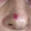 43. Basal Cell Carcinoma Nose Pictures