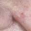 44. Basal Cell Carcinoma Nose Pictures