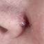 45. Basal Cell Carcinoma Nose Pictures