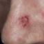 46. Basal Cell Carcinoma Nose Pictures