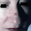47. Basal Cell Carcinoma Nose Pictures