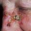 48. Basal Cell Carcinoma Nose Pictures