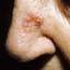49. Basal Cell Carcinoma Nose Pictures