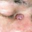 5. Basal Cell Carcinoma Nose Pictures