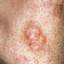 50. Basal Cell Carcinoma Nose Pictures