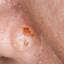 51. Basal Cell Carcinoma Nose Pictures
