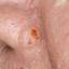 52. Basal Cell Carcinoma Nose Pictures