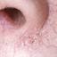 54. Basal Cell Carcinoma Nose Pictures