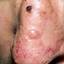 7. Basal Cell Carcinoma Nose Pictures