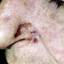 8. Basal Cell Carcinoma Nose Pictures