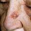 9. Basal Cell Carcinoma Nose Pictures