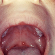 Chickenpox in Throat