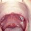 1. Chickenpox in Throat Pictures