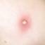 1. Mild Case of Chickenpox Pictures