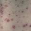 11. Mild Case of Chickenpox Pictures