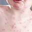 13. Mild Case of Chickenpox Pictures