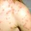 14. Mild Case of Chickenpox Pictures