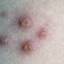 3. Mild Case of Chickenpox Pictures