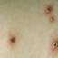 4. Mild Case of Chickenpox Pictures