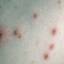 5. Mild Case of Chickenpox Pictures