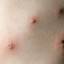 8. Mild Case of Chickenpox Pictures