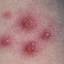 9. Mild Case of Chickenpox Pictures