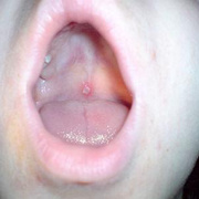 Chickenpox Mouth