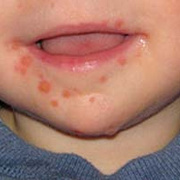 Viral Pemphigus in Children