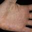 16. Dyshidrotic Eczema Pictures