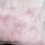 17. Dyshidrotic Eczema Pictures