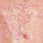 22. Dyshidrotic Eczema Pictures