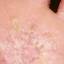 23. Dyshidrotic Eczema Pictures