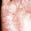 29. Dyshidrotic Eczema Pictures