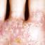 30. Dyshidrotic Eczema Pictures