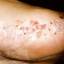 31. Dyshidrotic Eczema Pictures