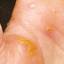36. Dyshidrotic Eczema Pictures