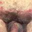 1. Folliculitis in Groin Pictures