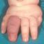 2. Hemangioma on Finger Pictures