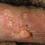 12. Genital Herpes Infection Pictures
