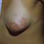 14. Genital Herpes Infection Pictures